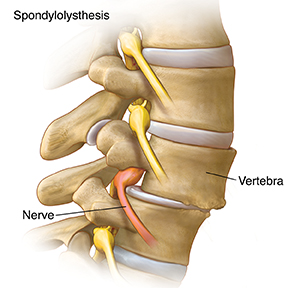 Side view of lumbar spine showing one vertebra slipping forward and pressing on nerve.