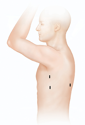 Side view of male torso showing possible incision sites for thoracoscopy.