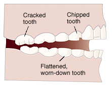 Side view of teeth and jaws showing cracked tooth, chipped tooth, and flattened, worn-down tooth.