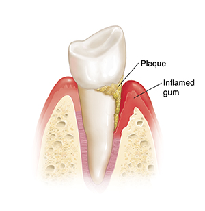 Side view of tooth in bone showing plaque and inflamed gum. 