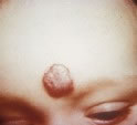 Strawberry Hemangioma - Forehead