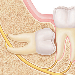 Teeth in cross section of jawbone. Wisdom tooth is in bone under gum, pointing forward to roots of next tooth.