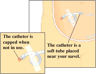 The catheter is a soft tube placed near your belly button. The catheter is capped when not in use.