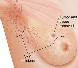 Three-quarter view of female underarm area showing breast anatomy ghosted in. Outline around tissue for simple mastectomy.