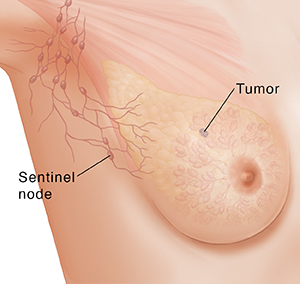 What is a Sentinel Lymph Node Breast Biopsy YourCareEverywhere