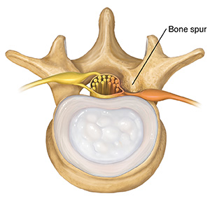 Top view of lumbar vertebra and disk showing bone spur pressing on spinal nerve.