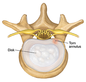 Top view of lumbar vertebra and disk showing tear in annulus.