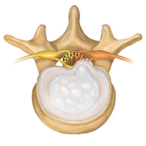 Top view of lumbar vertebra showing contained herniated disk.
