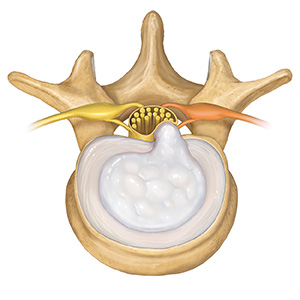 Top view of lumbar vertebra showing herniated disk.