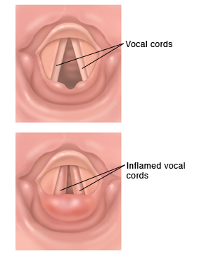 Top view of normal vocal cords. Top view of inflamed vocal cords.