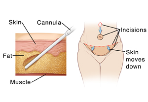 Two images: left one shows skin layers with cannula removing fat during liposuction; right one shows female abdomen with incisions for abdominoplasty.