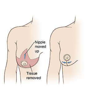 Two images of female chest showing right breast: First figure shows incisions for vertical breast reduction surgery; second image shows result.