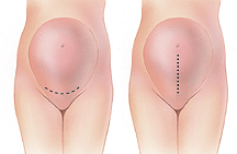 Types of incisions