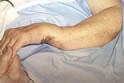 Wrist Fracture with Deformity