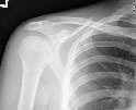 X-Ray - Normal Shoulder