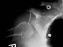 X-Ray - Shoulder Dislocation