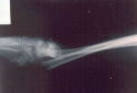 X-Ray - Wrist Fracture