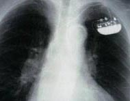 X-ray of a single-chamber implanted pacemaker