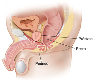 biopsia de prostata posibles complicaciones)
