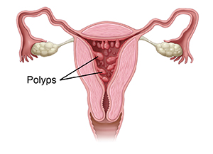 Front view cross section of female reproductive tract showing polyps in uterus.