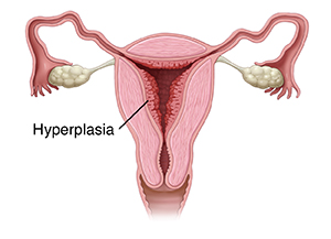 Front view cross section of female reproductive tract showing endometrial hyperplasia.