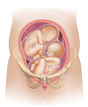 Front view cross section of uterus in pelvic bones showing two fetuses.