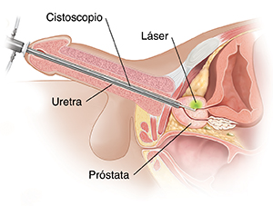 Cancer de prostata sin operacion, Cancer de colon operacion complicaciones