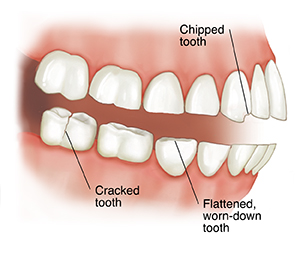 what is clenching teeth a symptom of