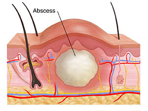 ir drainage of abscess