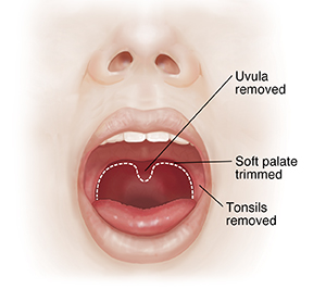 will getting your tonsils removed stop snoring