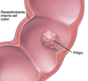 Qué son los pólipos del colon y el recto