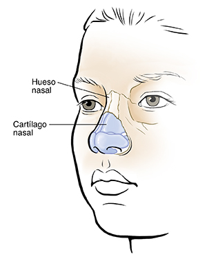 Qué es una nariz rota (fractura nasal) en los niños?