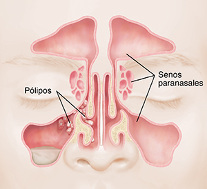 Qué son los pólipos nasales?