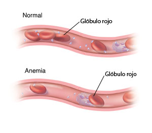 anemia y cancer giardia la pielea oamenilor