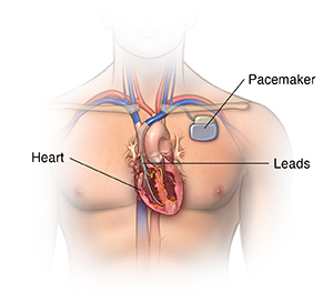 Heart Block  Cedars-Sinai