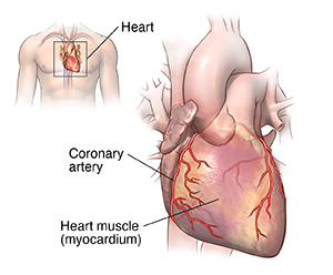 Angina Pectoris Cedars Sinai