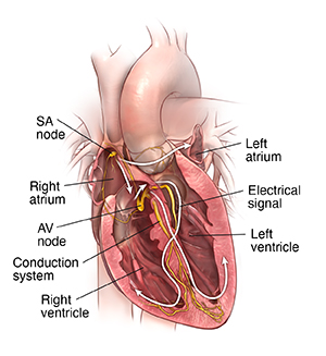 arrhythmia