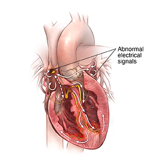 arrhythmia