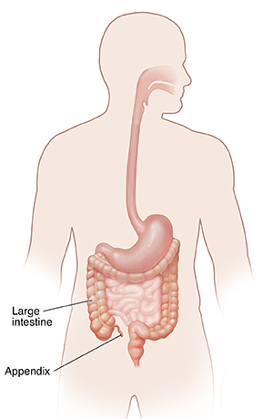 appendix burst symptoms