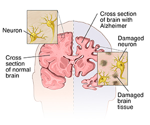 Things That Slow Down Alzheimer's Disease