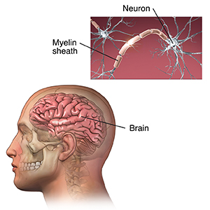 The Skid Marks MS Leaves on the Brain