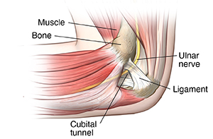 Treating Cubital Tunnel Syndrome  Cubital Tunnel Syndrome, Elbow