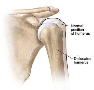 shoulder dislocation