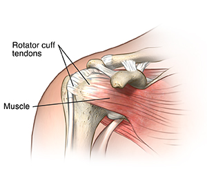 What causes a torn rotator deals cuff