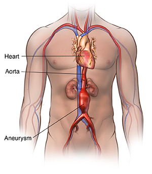 abdominal aortic aneurysm xray