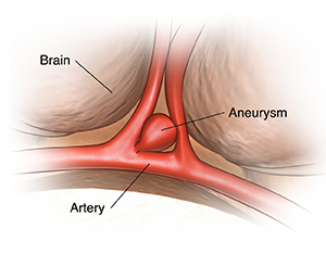 Closeup view of the brain showing aneurysm on artery.
