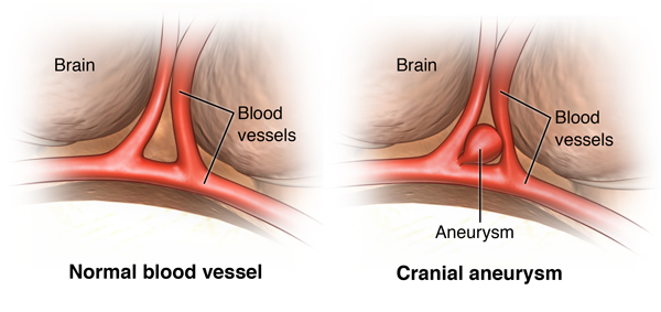 Increased Intracranial Pressure Icp Cedars Sinai