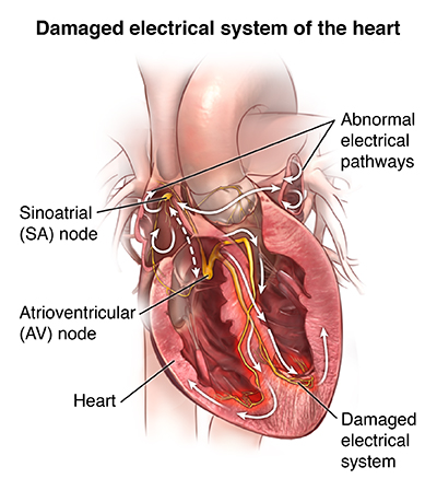 can low blood pressure cause heart arrhythmia)