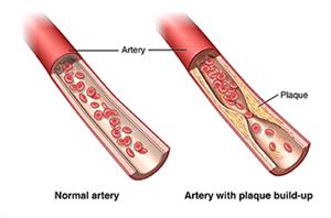 Normal artery and artery with plaque buildup