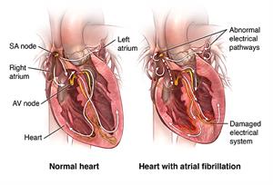 Normal heart and heart with atrial fibrillation